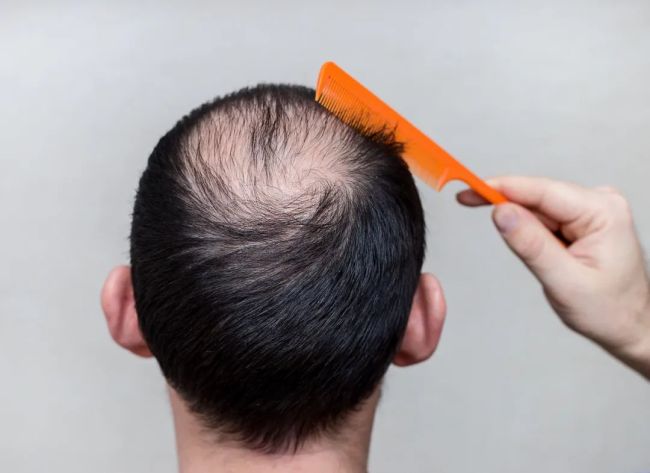 探寻脱发年轻化困扰 干细胞移植新解脱发之苦 第1张