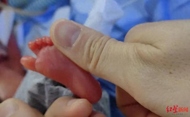 出生仅700余克巴掌宝宝平安出院 超早产奇迹存活 第1张